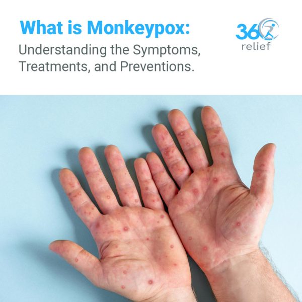 What Is Monkeypox: Understanding The Symptoms, Treatments, And ...